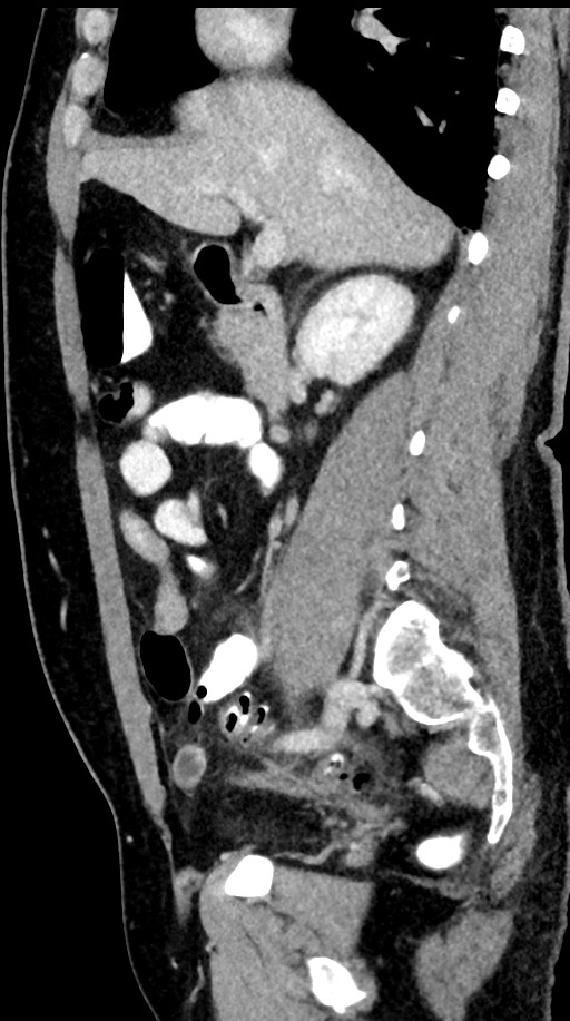 Acute appendicitis (Radiopaedia 77016-88960 Sagittal C+ portal venous phase 71).jpg