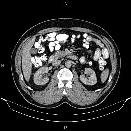 Acute appendicitis (Radiopaedia 84780-100240 Axial C+ portal venous phase 43).jpg