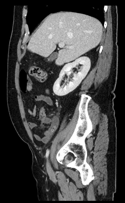Acute appendicitis - large appendicoliths (Radiopaedia 61805-69820 Sagittal C+ portal venous phase 81).jpg