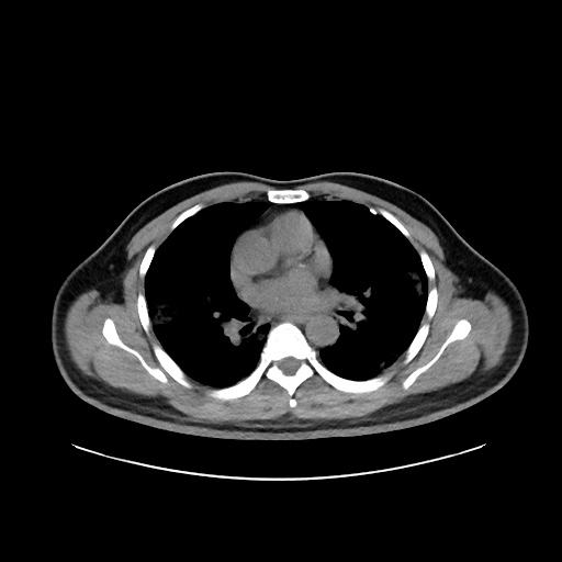 Acute appendicitis and COVID 19 pneumonia (Radiopaedia 76604-88380 Axial non-contrast 27).jpg