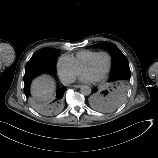 Acute aspiration pneumonitis (Radiopaedia 55642-62166 Axial liver window 45).jpg
