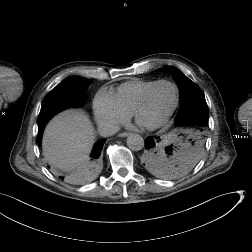 Acute aspiration pneumonitis (Radiopaedia 55642-62166 Axial liver window 47).jpg