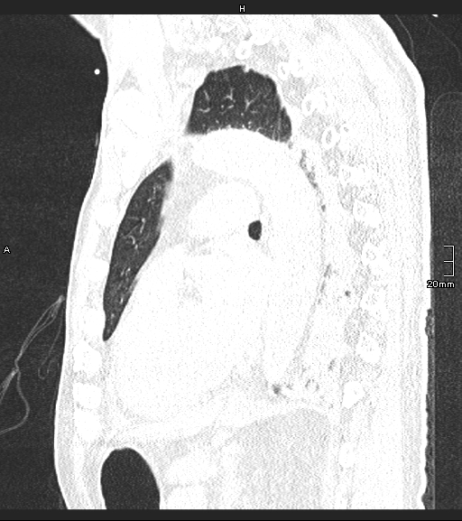 Acute aspiration pneumonitis (Radiopaedia 55642-62166 Sagittal lung window 58).jpg
