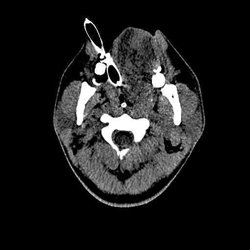 Acute basilar artery occlusion (Radiopaedia 43582-46985 Axial non-contrast 1).jpg