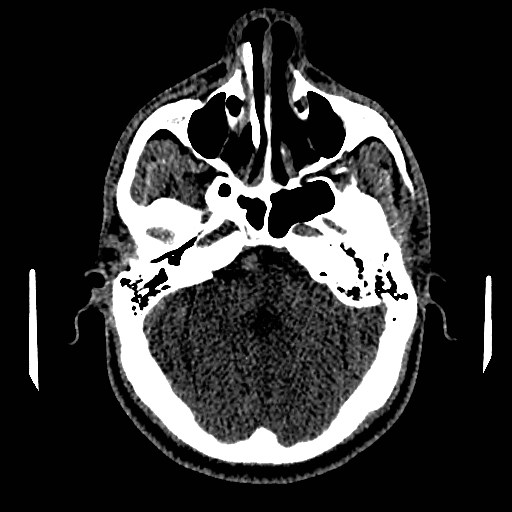 Acute basilar artery occlusion (Radiopaedia 43582-46985 Axial non-contrast 57).jpg