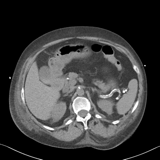 File:Acute bleed from gastric fundus biopsy site (Radiopaedia 35201-36737 Axial non-contrast 25).png