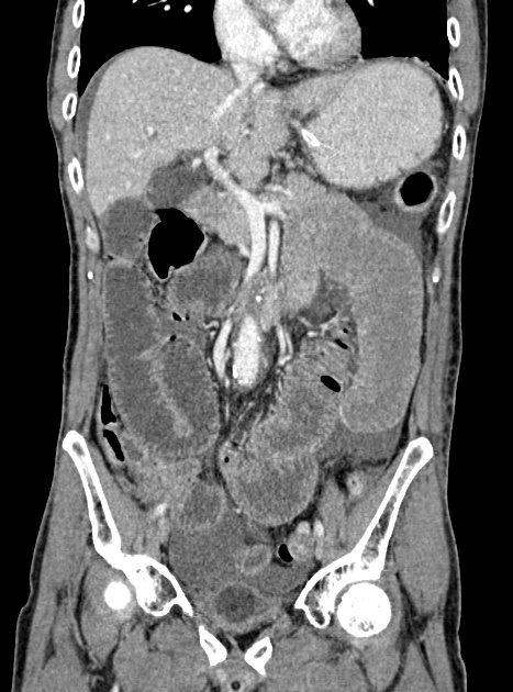 Acute bowel ischemia (Radiopaedia 87695-104114 Coronal C+ portal venous phase 182).jpg
