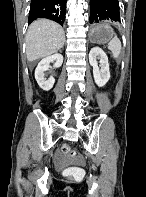 Acute bowel ischemia (Radiopaedia 87695-104114 Coronal C+ portal venous phase 280).jpg