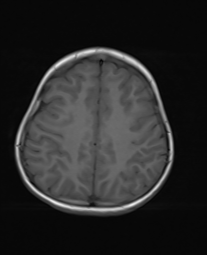 File:Acute cerebellar ataxia (Radiopaedia 61487-69446 Axial T1 17).jpg