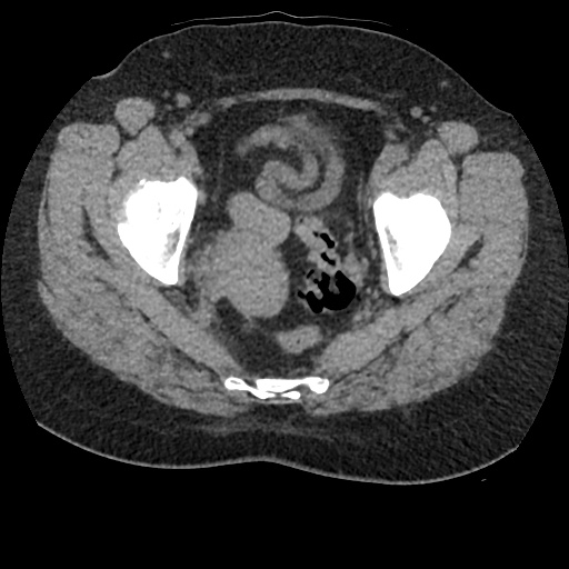 File:Acute cholecystitis and ureteric colic (Radiopaedia 42330-45444 Axial prone 98).jpg