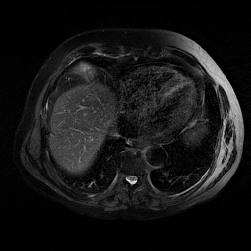 File:Acute cholecystitis complicated by pylephlebitis (Radiopaedia 65782-74915 Axial T2 fat sat 5).jpg