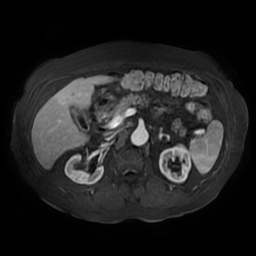 Acute cholecystitis complicated by pylephlebitis (Radiopaedia 65782-74915 Axial arterioportal phase T1 C+ fat sat 66).jpg