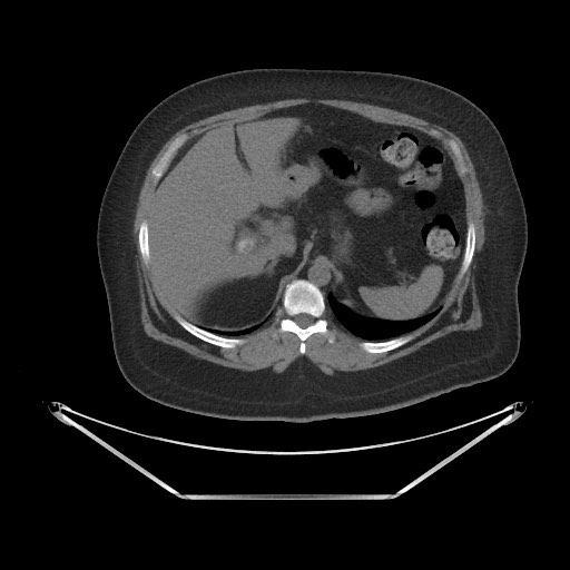 Acute cholecystitis with tensile fundus sign (Radiopaedia 71394-81723 Axial non-contrast 10).jpg