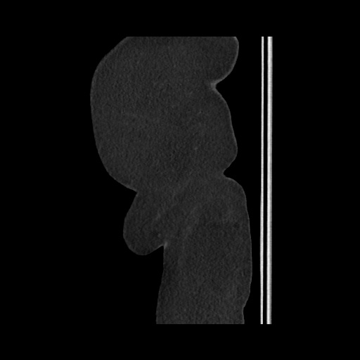 File:Acute cholecystitis with tensile fundus sign (Radiopaedia 71394-81723 Sagittal non-contrast 162).jpg