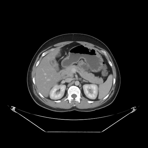 File:Acute complicated calculous cholecystitis (Radiopaedia 55202-61587 Axial C+ delayed 36).jpg