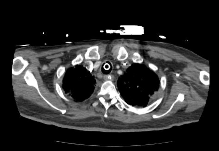 Acute cor pulmonale (ultrasound) (Radiopaedia 83508-98818 Axial C+ CTPA 6).jpg