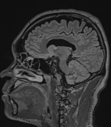 Acute disseminated encephalomyelitis (ADEM)- Anti-NMDA receptor encephalitis (Radiopaedia 54920-61201 Sagittal FLAIR 39).png