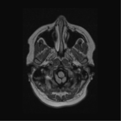Acute disseminated encephalomyelitis (ADEM) (Radiopaedia 38073-40065 Axial FLAIR 4).png