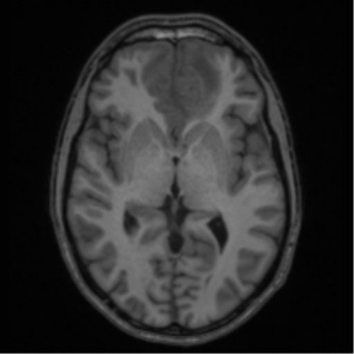Acute disseminated encephalomyelitis (ADEM) (Radiopaedia 65319-74349 Axial T1 31).png