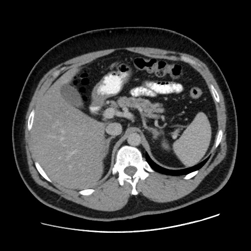 File:Acute diverticulitis with localized perforation (Radiopaedia 41296-44113 Axial C+ portal venous phase 26).jpg
