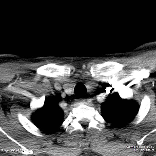 Acute epiglottitis (Radiopaedia 54375-60590 Axial C+ arterial phase 60).jpg