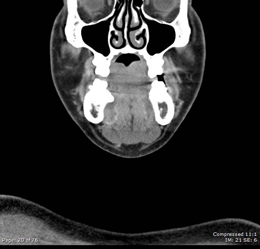 Acute epiglottitis (Radiopaedia 54375-60590 Coronal C+ arterial phase 20).jpg