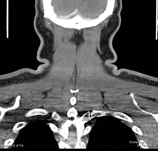 Acute epiglottitis (Radiopaedia 54375-60590 Coronal C+ arterial phase 63).jpg