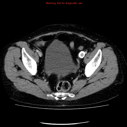 Acute gangrenous cholecystitis (Radiopaedia 10123-10661 Axial C+ portal venous phase 88).jpg