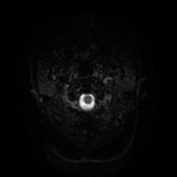 Acute internal carotid artery dissection (Radiopaedia 53541-59632 Axial DWI 32).jpg