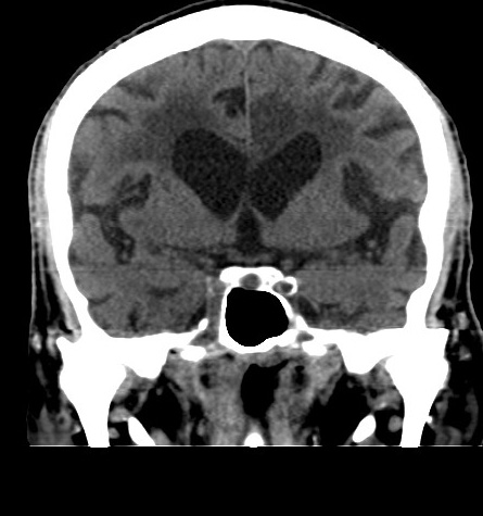 File:Acute left anterior cerebral artery territory infarction (Radiopaedia 51785-57578 Coronal non-contrast 26).jpg