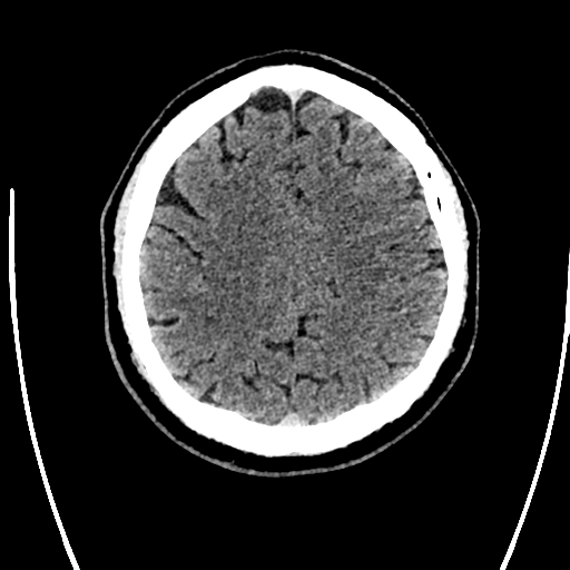 File:Acute left middle cerebral artery territory ischemic stroke (Radiopaedia 35688-37223 Axial non-contrast 60).png