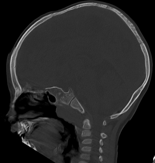 Acute mastoiditis (Radiopaedia 82678-96881 Sagittal bone window 34).jpg