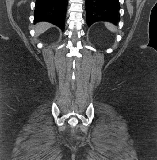 Acute mesenteric venous ischemia (Radiopaedia 46041-50383 Coronal C+ portal venous phase 81).jpg