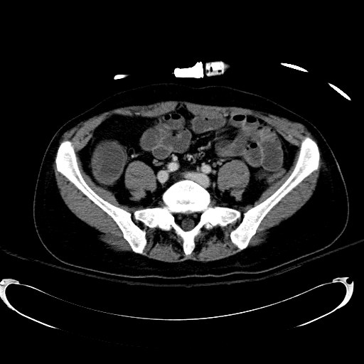 Acute myocardial infarction in CT (Radiopaedia 39947-42415 Axial C+ portal venous phase 90).jpg