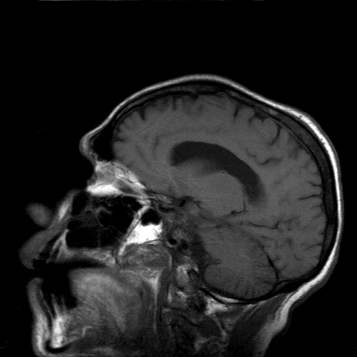 File:Acute necrotizing toxoplasma encephalitis (Radiopaedia 10683-11149 Sagittal T1 fat sat 12).jpg