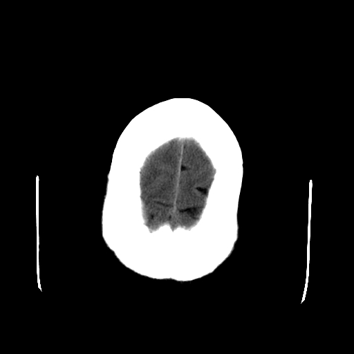 File:Acute necrotizing toxoplasma encephalitis (Radiopaedia 10683-11150 Axial non-contrast 6).jpg