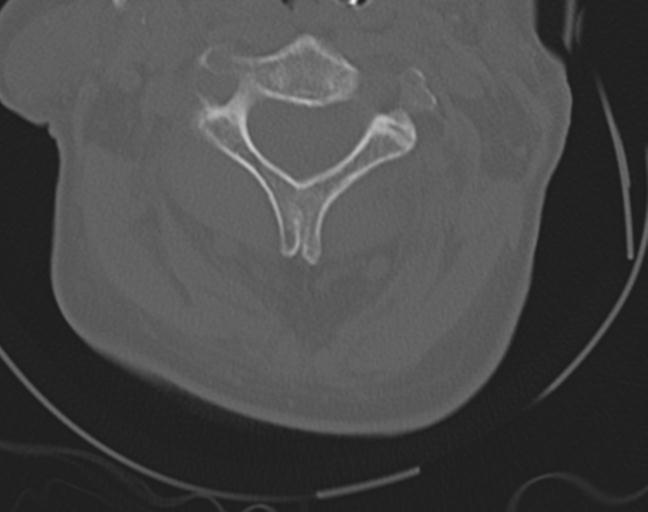 Acute on chronic subdural hematoma and thoracic vertebral injury in a multitrauma patient (Radiopaedia 31698-32619 Axial bone window 20).jpg
