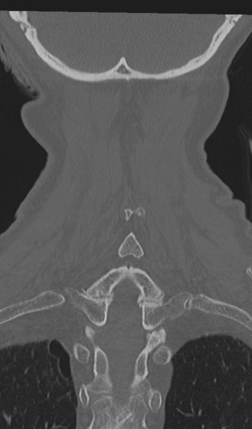Acute on chronic subdural hematoma and thoracic vertebral injury in a multitrauma patient (Radiopaedia 31698-32619 Coronal bone window 54).jpg