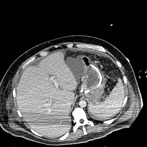 File:Acute pancreatic necrosis (Radiopaedia 13560-18501 Axial C+ portal venous phase 24).jpg