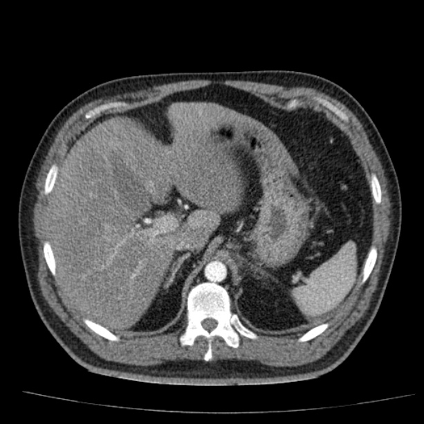 Acute pancreatitis (Radiopaedia 26663-26813 Axial C+ arterial phase 26).jpg