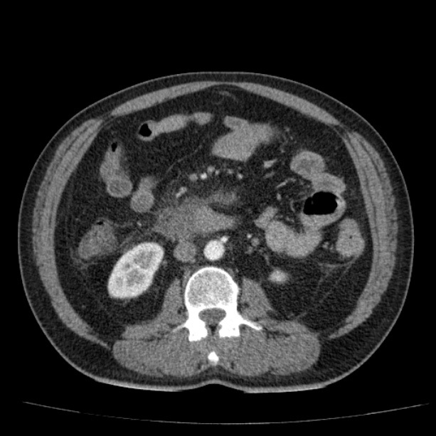Acute pancreatitis (Radiopaedia 26663-26813 Axial C+ arterial phase 53).jpg