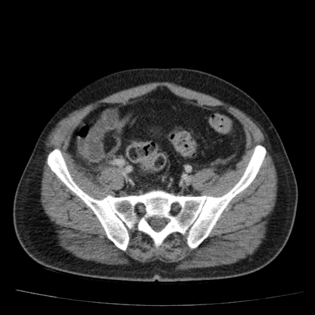 Acute pancreatitis (Radiopaedia 26663-26813 Axial C+ portal venous phase 67).jpg