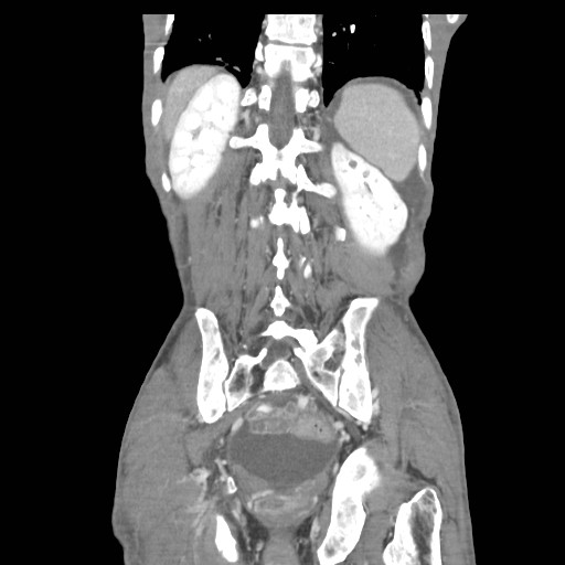File:Acute pancreatitis (Radiopaedia 50213-55558 Coronal C+ portal venous phase 38).jpg