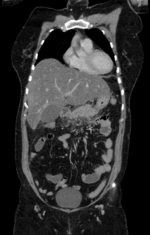 Acute pancreatitis (Radiopaedia 80007-93285 Coronal C+ portal venous phase 39).jpg