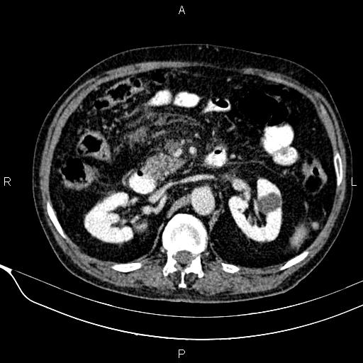 Acute pancreatitis (Radiopaedia 85146-100701 Axial C+ portal venous phase 28).jpg