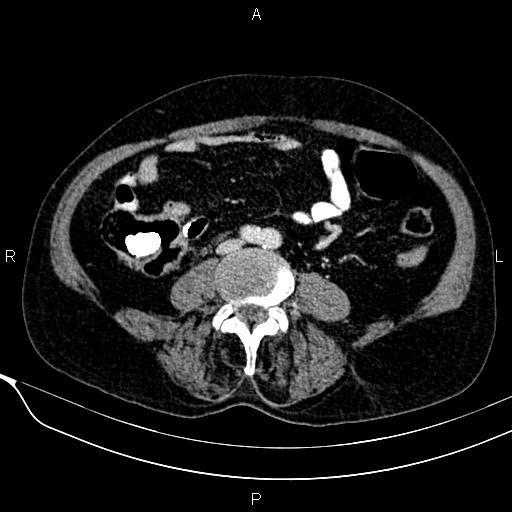 Acute pancreatitis (Radiopaedia 85146-100701 Axial C+ portal venous phase 42).jpg