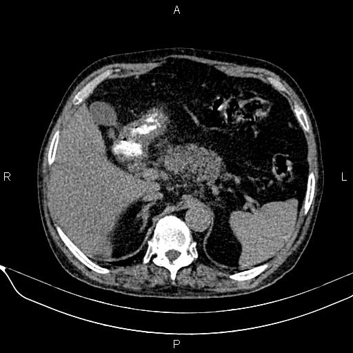 Acute pancreatitis (Radiopaedia 85146-100701 Axial non-contrast 36).jpg