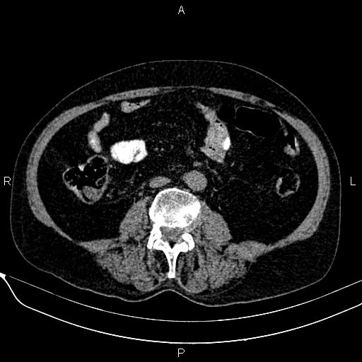 Acute pancreatitis (Radiopaedia 85146-100701 Axial non-contrast 72).jpg