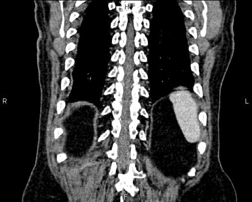 Acute pancreatitis (Radiopaedia 85146-100701 Coronal C+ portal venous phase 66).jpg