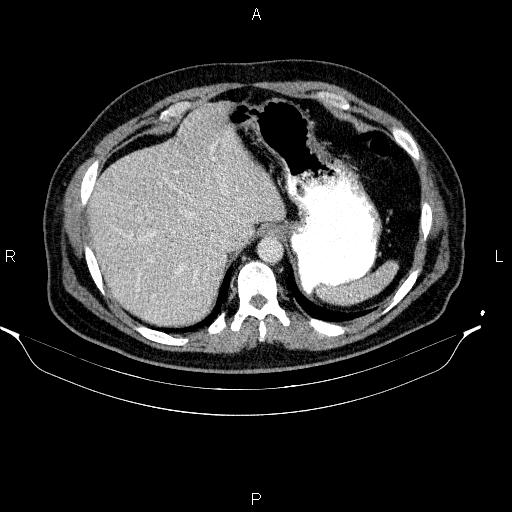 File:Acute pancreatitis (Radiopaedia 85390-101010 Axial C+ portal venous phase 18).jpg